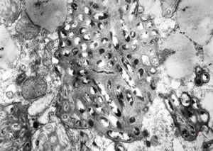Whipple disease Whipple disease